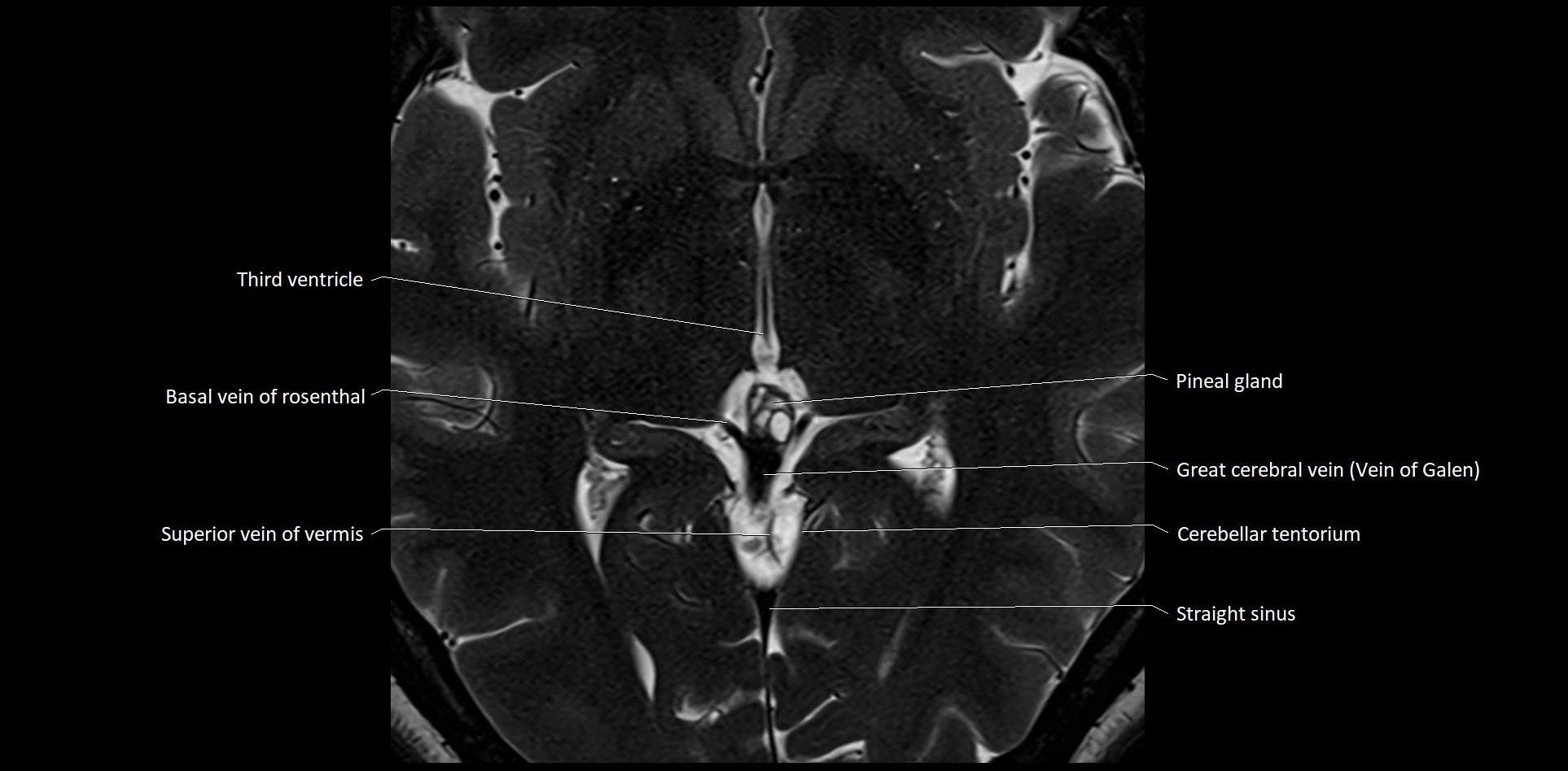 MRI Cerebellar anatomy High-resolution labelled 3T MRI image 30.webp